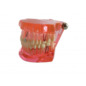 Educational Restoration Model w/Implant