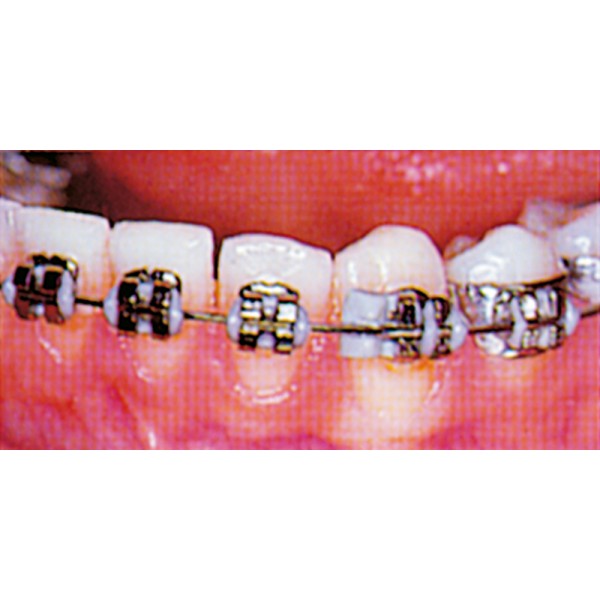 Dentalastics ® Rotation Wedges - 100 pieces