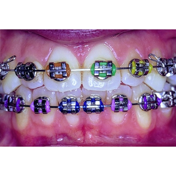Dentalastics ® Personal Colored Plastic Ligatures/Assortment - 1 assortment