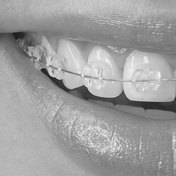 Crystal Brackets 3-3