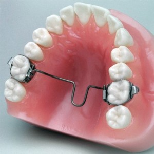 TPA - TRANSPALATAL ARCH