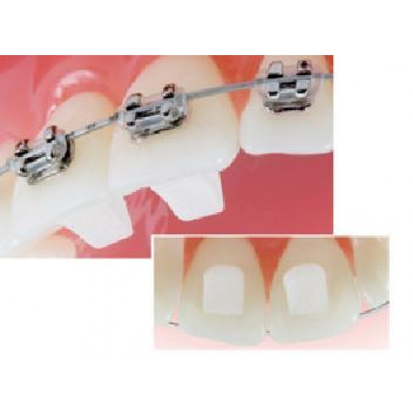 What Can Rubber Bands Do for My Bite? - iSmile Orthodontics