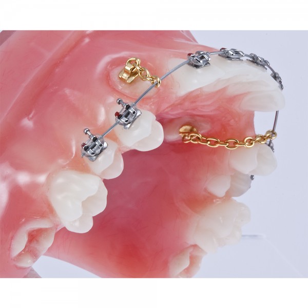 Eruption Appliance Typondont