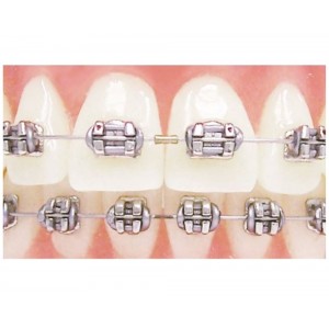 Ortho Specialties Gold Tone Crimpable Stops, 2mm (500 ct)