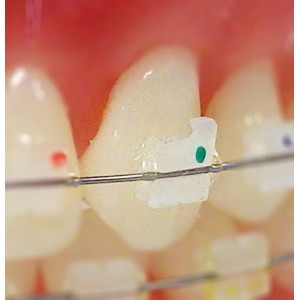 Accent™ Ceramic Brackets, Roth (5 ct)