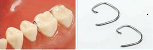 NEET Springs - Small-cuspid, large-molar (25/pk) (31834)